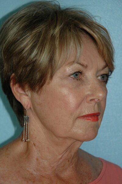 Face & Neck Lift Case 156 Before Photo Face & Neck Lift