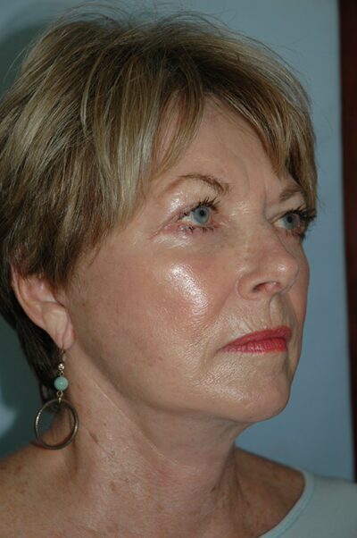 Face & Neck Lift Case 156 After Photo Face & Neck Lift