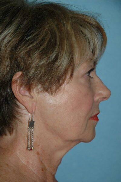 Face & Neck Lift Case 156 Before Photo Face & Neck Lift