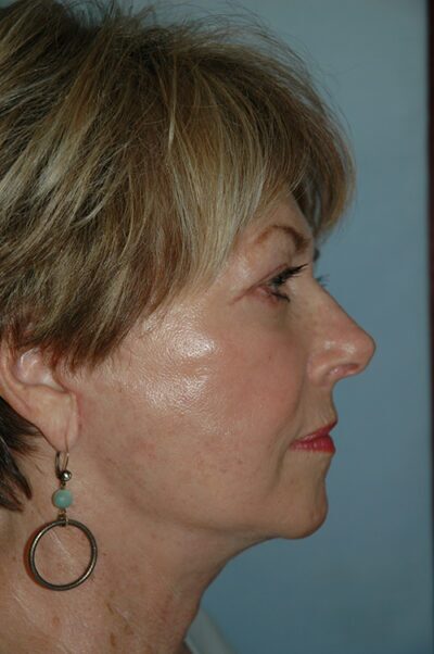 Face & Neck Lift Case 156 After Photo Face & Neck Lift