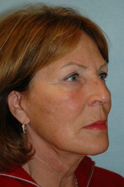 Face & Neck Lift Case 157 After Photo Face & Neck Lift