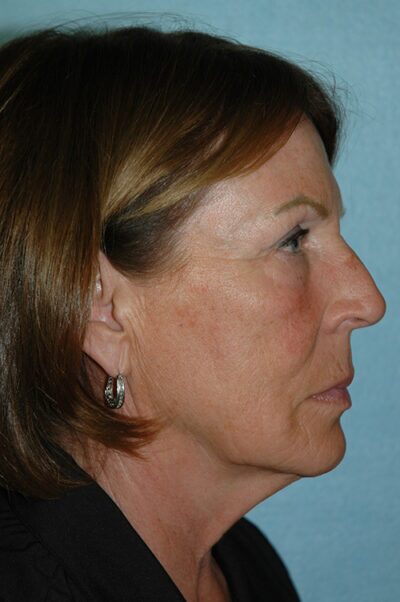 Face & Neck Lift Case 157 Before Photo Face & Neck Lift