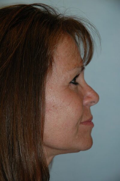 Face & Neck Lift Case 154 After Photo Face & Neck Lift