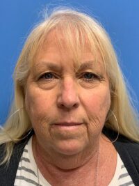 Face & Neck Lift