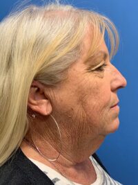 Face & Neck Lift