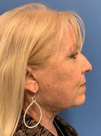 Face & Neck Lift