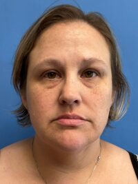 Face & Neck Lift