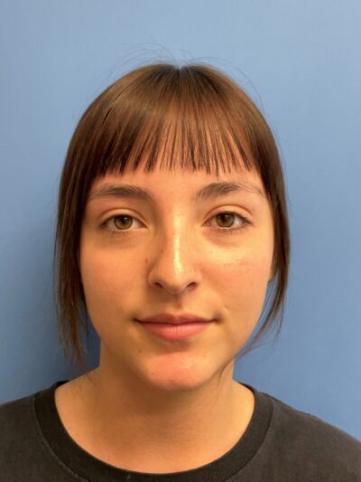 Rhinoplasty