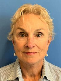 Face & Neck Lift