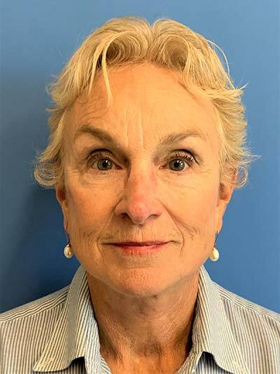Face & Neck Lift Case 713 After Photo Face & Neck Lift