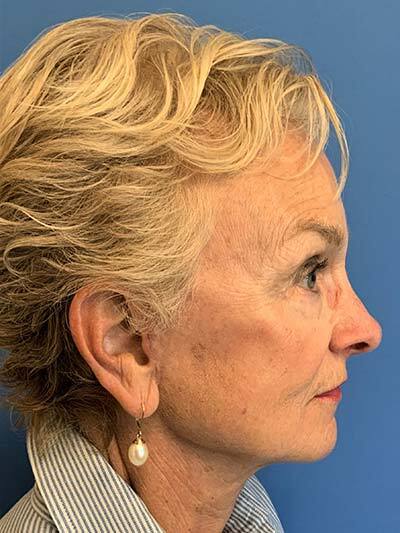 Face & Neck Lift Case 713 After Photo Face & Neck Lift