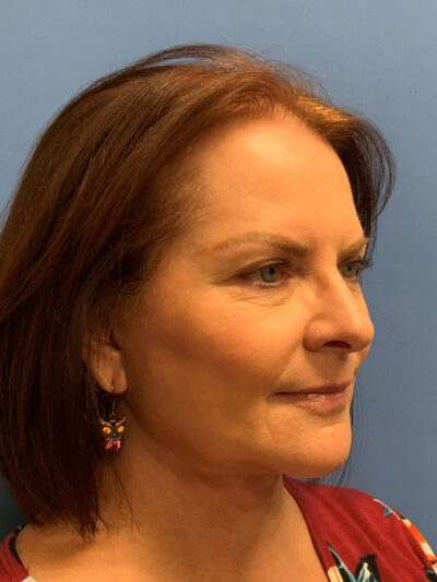Face & Neck Lift Case 793 After Photo Face & Neck Lift