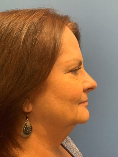 Face & Neck Lift Case 793 Before Photo Face & Neck Lift