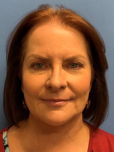 Face & Neck Lift Case 793 After Photo Face & Neck Lift