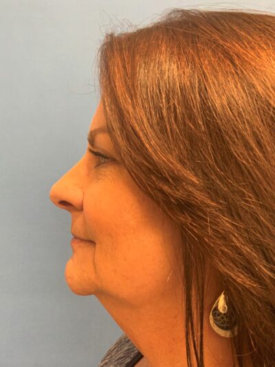 Face & Neck Lift Case 793 Before Photo Face & Neck Lift