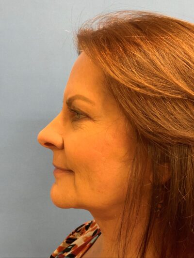 Face & Neck Lift Case 793 After Photo Face & Neck Lift