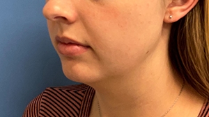 Chin Augmentation