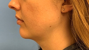 Chin Augmentation
