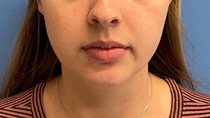 Chin Augmentation