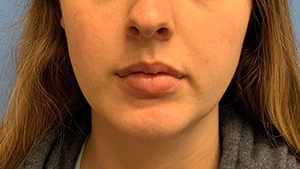 Chin Augmentation