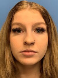 Rhinoplasty