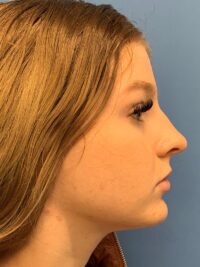 Rhinoplasty