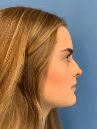 Rhinoplasty