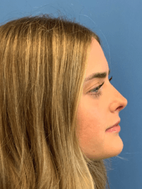 Rhinoplasty
