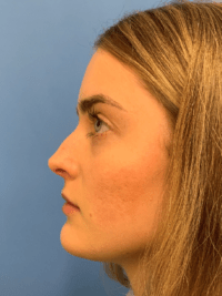 Rhinoplasty