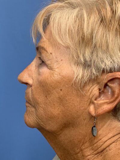 Blepharoplasty & Browlift