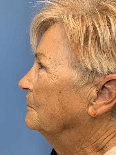 Blepharoplasty & Browlift