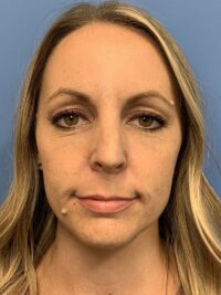 Face Procedures