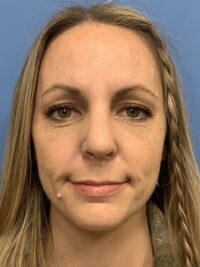 Face Procedures