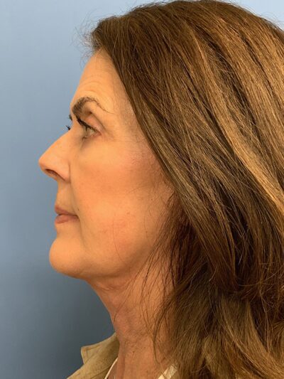Face & Neck Lift