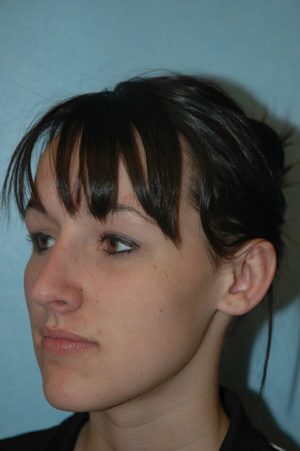 Otoplasty/Ear Pinning
