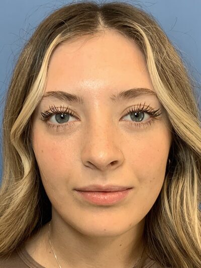 Rhinoplasty Case 37593 After Photo Rhinoplasty