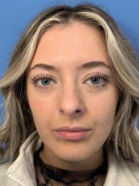 Rhinoplasty