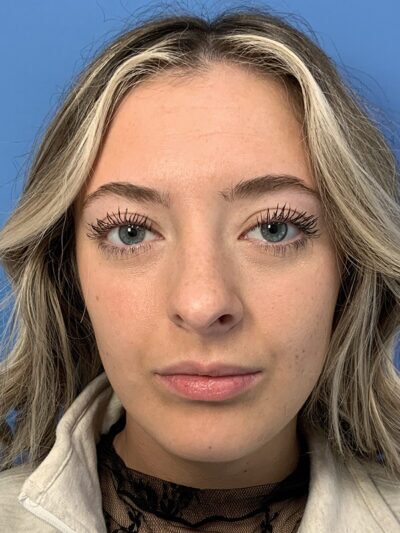 Rhinoplasty Case 37593 Before Photo Rhinoplasty