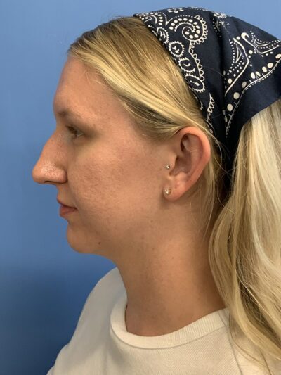 Rhinoplasty