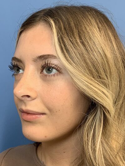 Rhinoplasty Case 37593 After Photo Rhinoplasty
