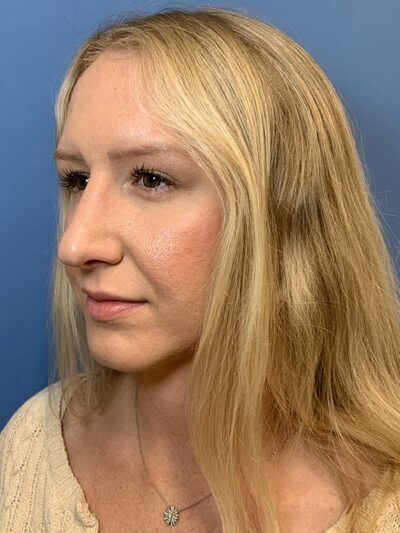 Rhinoplasty