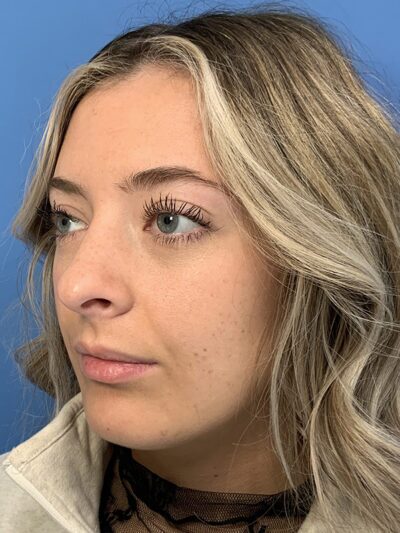 Rhinoplasty Case 37593 Before Photo Rhinoplasty