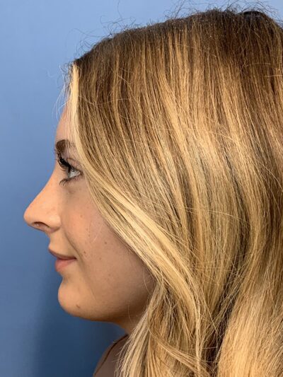 Rhinoplasty Case 37593 After Photo Rhinoplasty