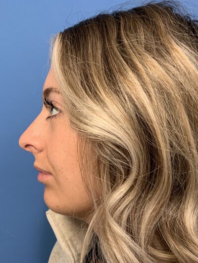 Rhinoplasty Case 37593 Before Photo Rhinoplasty