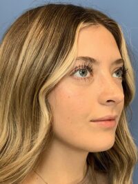 Rhinoplasty