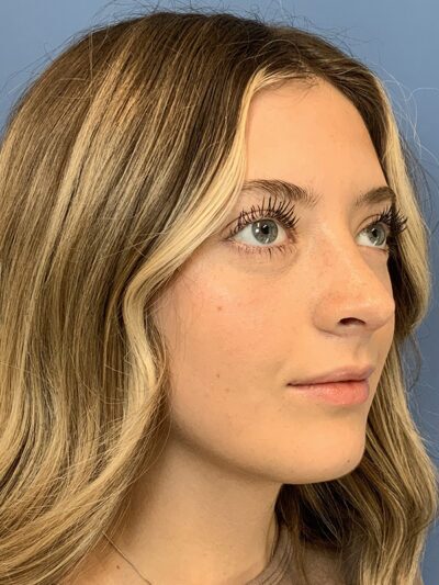 Rhinoplasty Case 37593 After Photo Rhinoplasty
