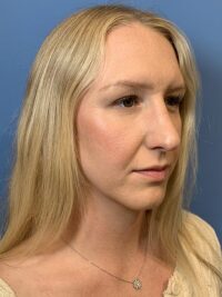 Rhinoplasty