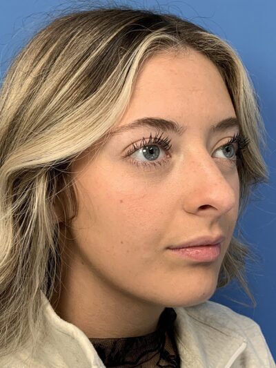 Rhinoplasty Case 37593 Before Photo Rhinoplasty