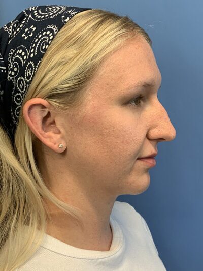 Rhinoplasty