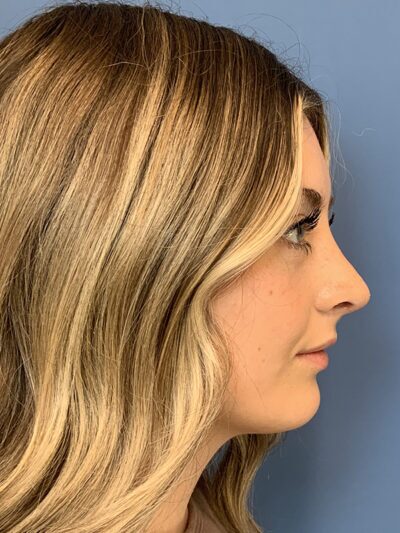 Rhinoplasty Case 37593 After Photo Rhinoplasty